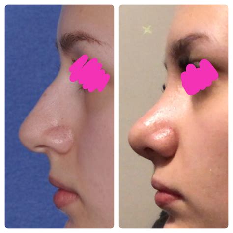 Certain minor problems may be addressed; however, your surgeon may advise you to wait up to a year <b>after</b> the original procedure before making a decision to have. . Hit my nose 5 weeks after rhinoplasty